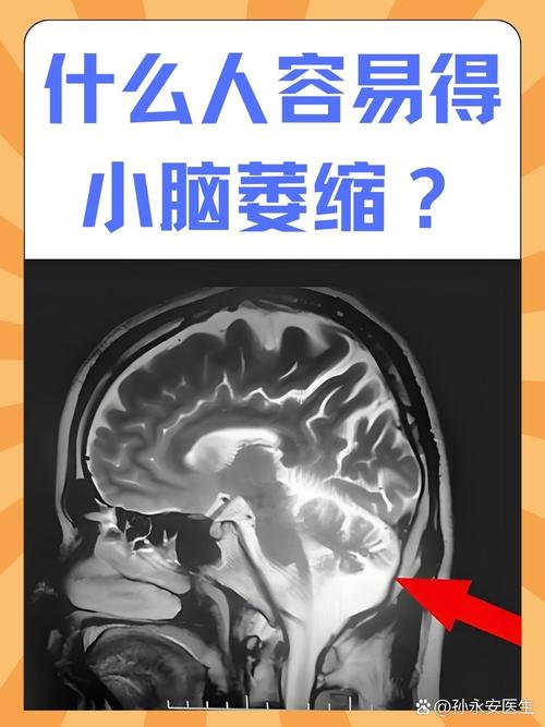 送小脑萎缩儿子高考,小脑萎缩能上学吗